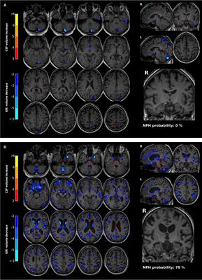 Automatic MRI volumetry in asymptomatic cases at risk for normal pressure hydrocephalus